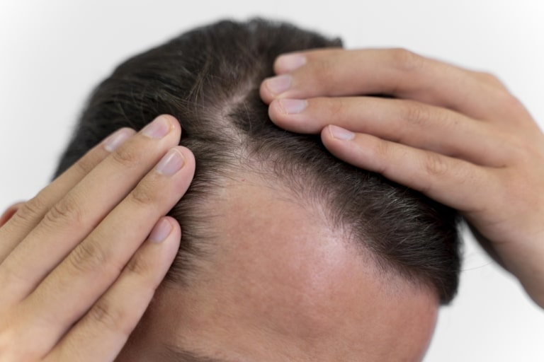 Un homme montre la chute de cheveux dont il souffre