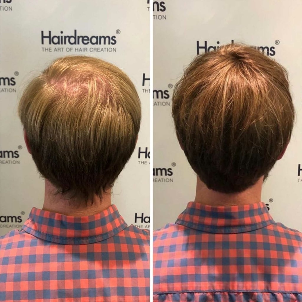 Vorher-Nachher-Bild einer Haartransplantation bei einem Mann mit braunen Haar