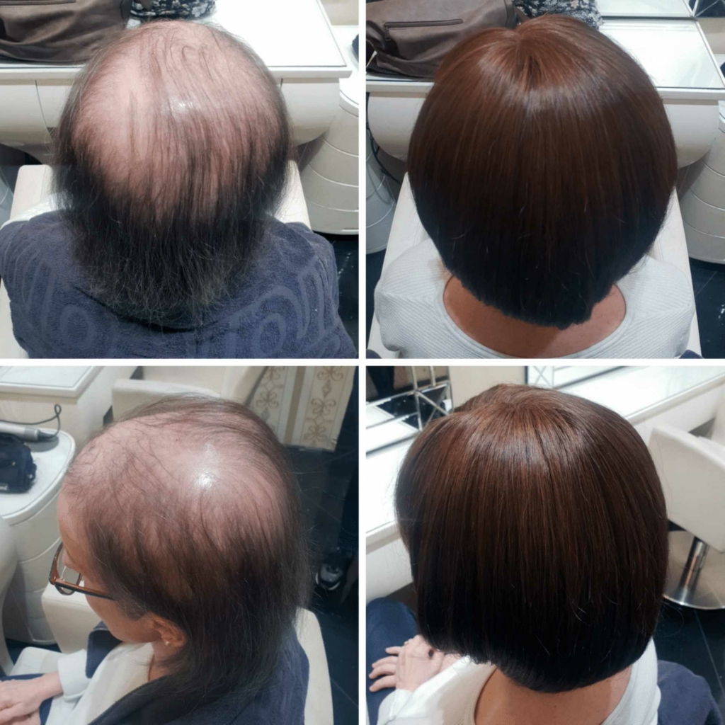 Progression from hair loss to thick hair with hair thickening MicroLines