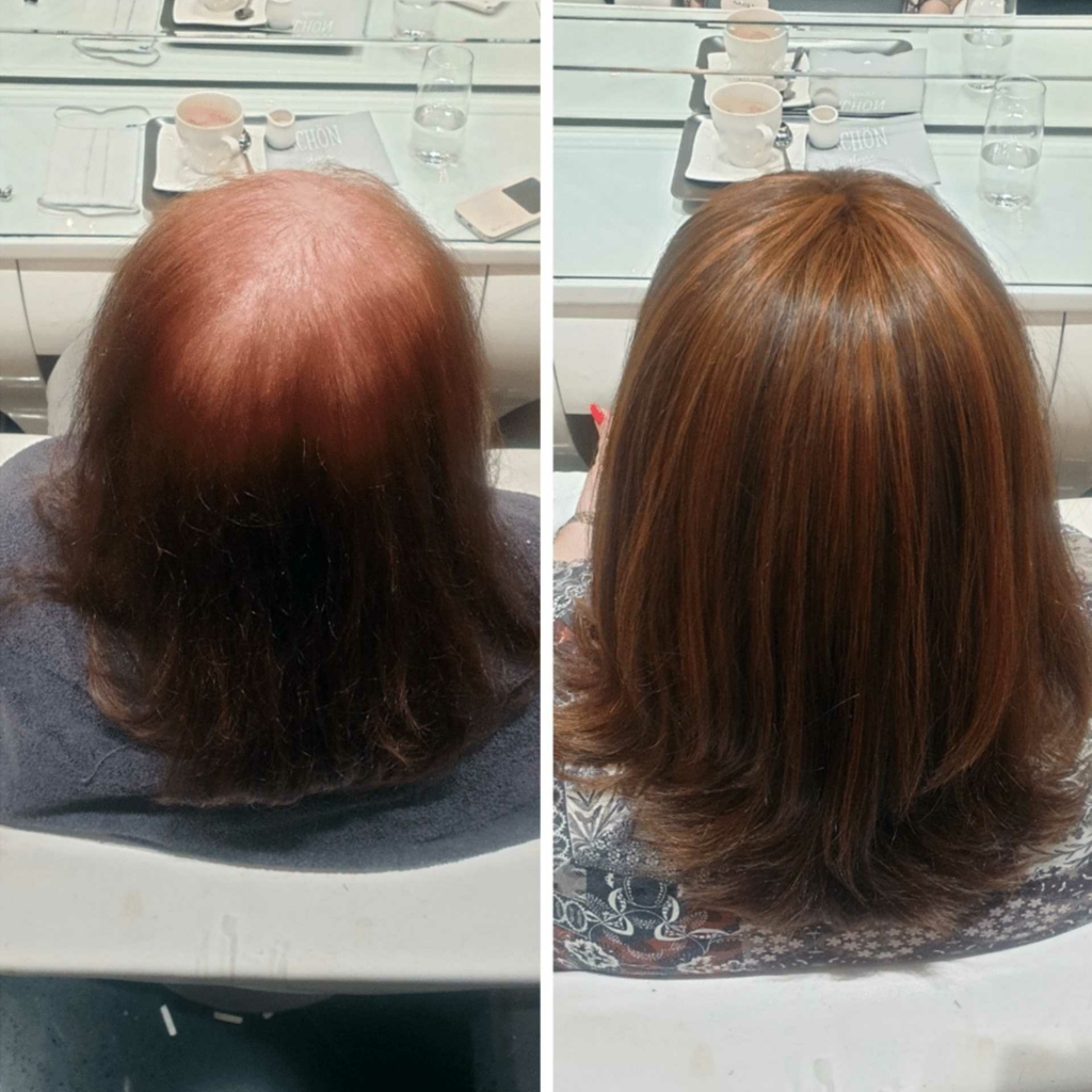 Vorher-Nachher-Bild von Haarausfall zu vollem Haar mit Haarverdichtung MicroLines