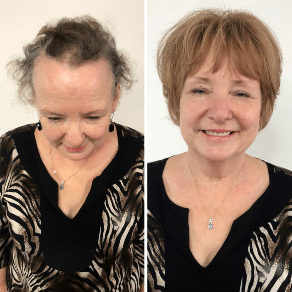 Ergebnis vor und nach einer Haarverdichtung mit Hairdreams-MicroLines