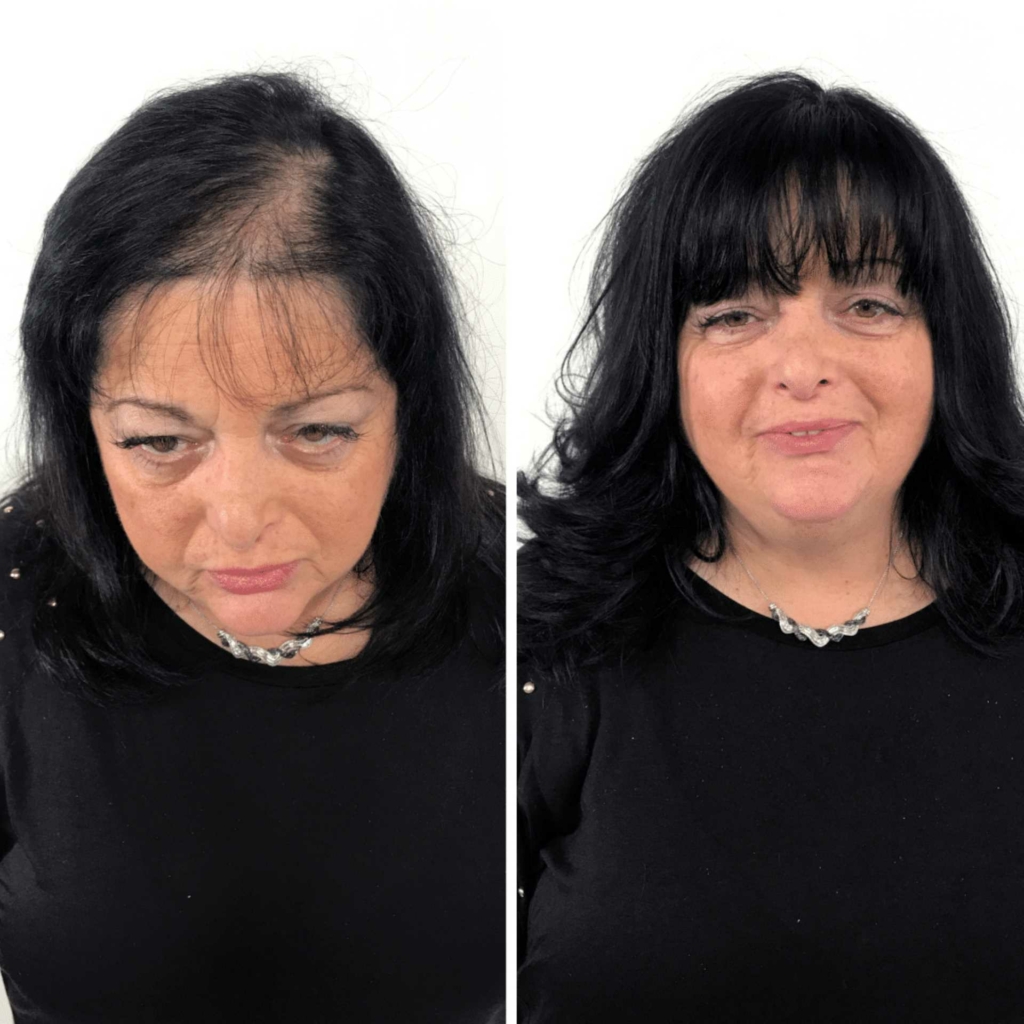 before and after woman wearing a Hairdreams Microlines