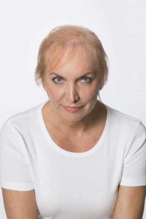 Woman with hair loss proble,ms and thin blonde hair