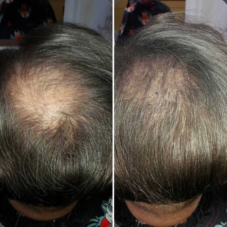 Photos avant/après de la thérapie capillaire Stop&Grow Hairdeams