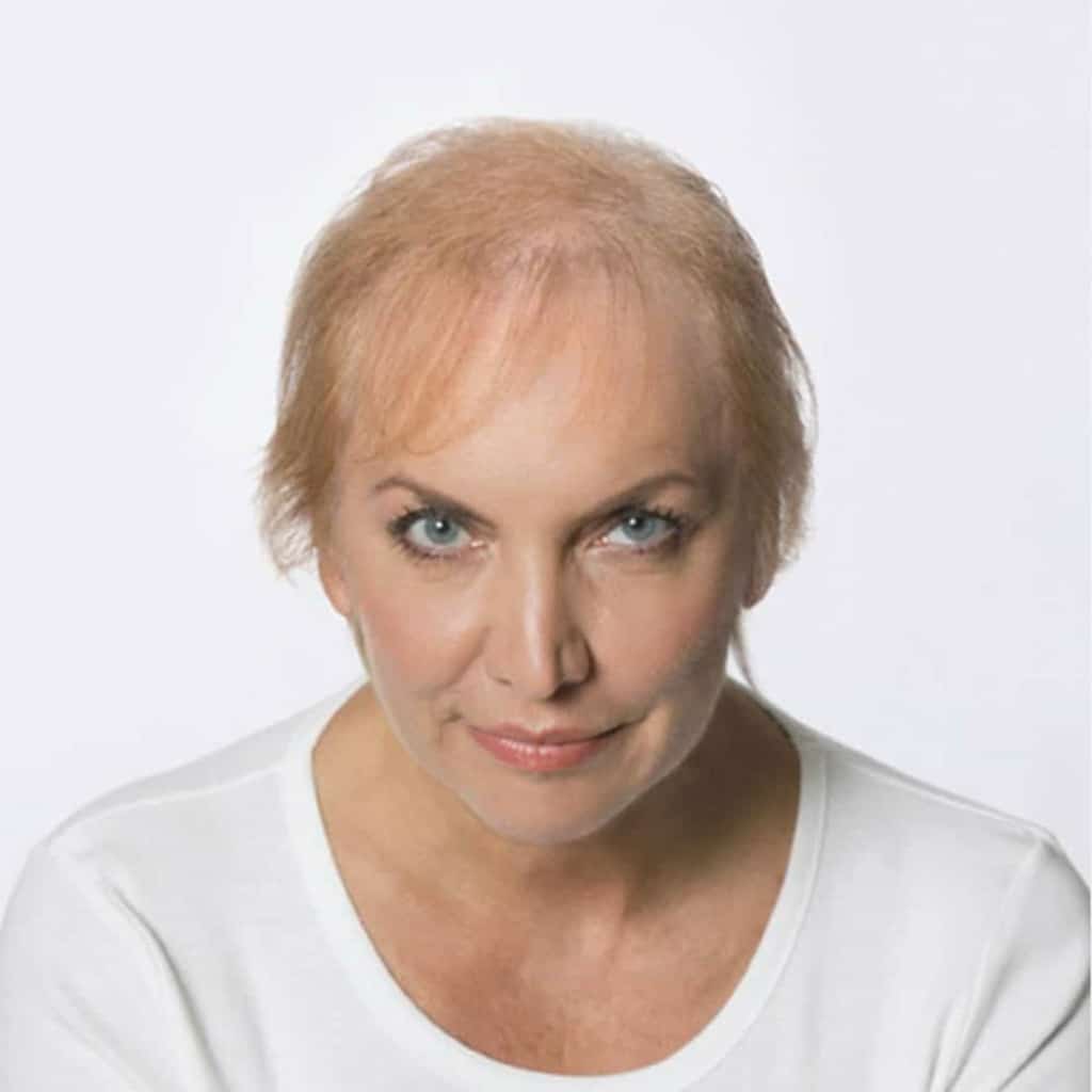 Foto voor haarverdikking bovenop het hoofd van een vrouw met kort blond haar