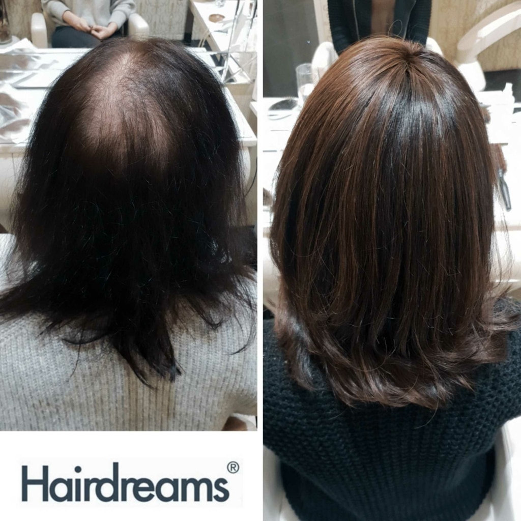 Before and after picture of hair thickening on a woman with dark hair