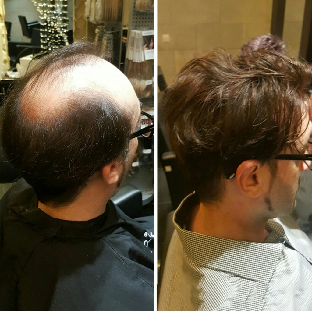 Before and after pictures of hair thickening with Folium