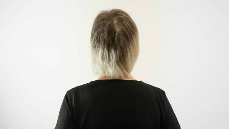 Woman with thin hair on the top of her head
